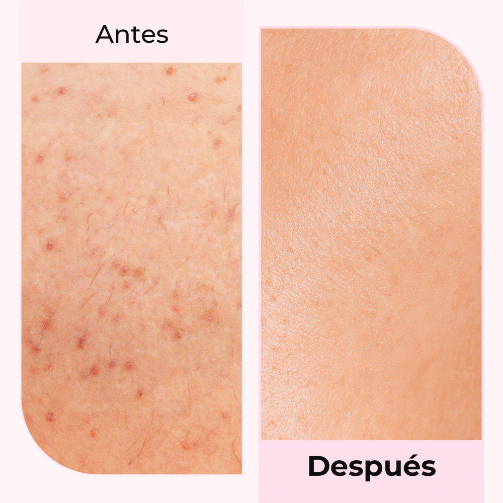 Comparación de piel irritada vs. piel calmada con Silky Balloon – Resultados rápidos y eficaces.