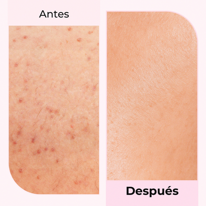 Comparación de piel irritada vs. piel calmada con Silky Balloon – Resultados rápidos y eficaces.